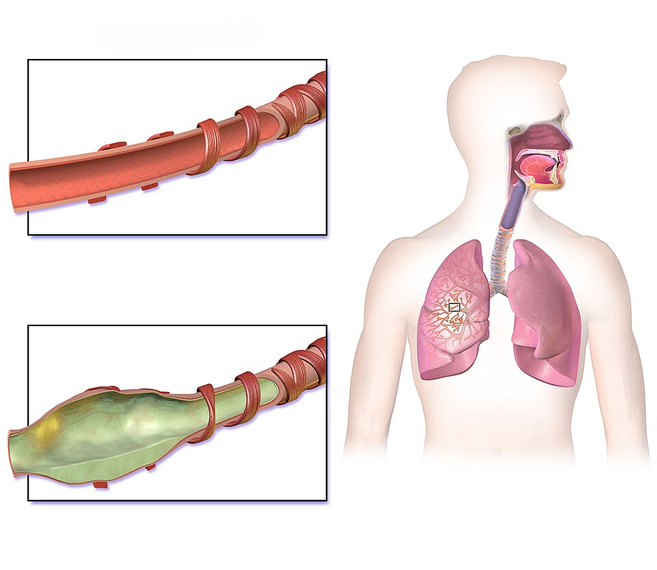 Anatomia Comparativa: Brônquio saudável vs. brônquio com bronquiectasia