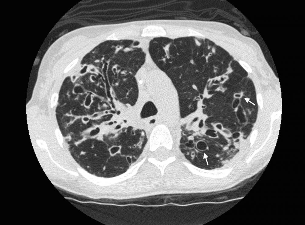 Tomografia de Alta Resolução mostrando bronquiectasias císticas e sinal do anel de sinete