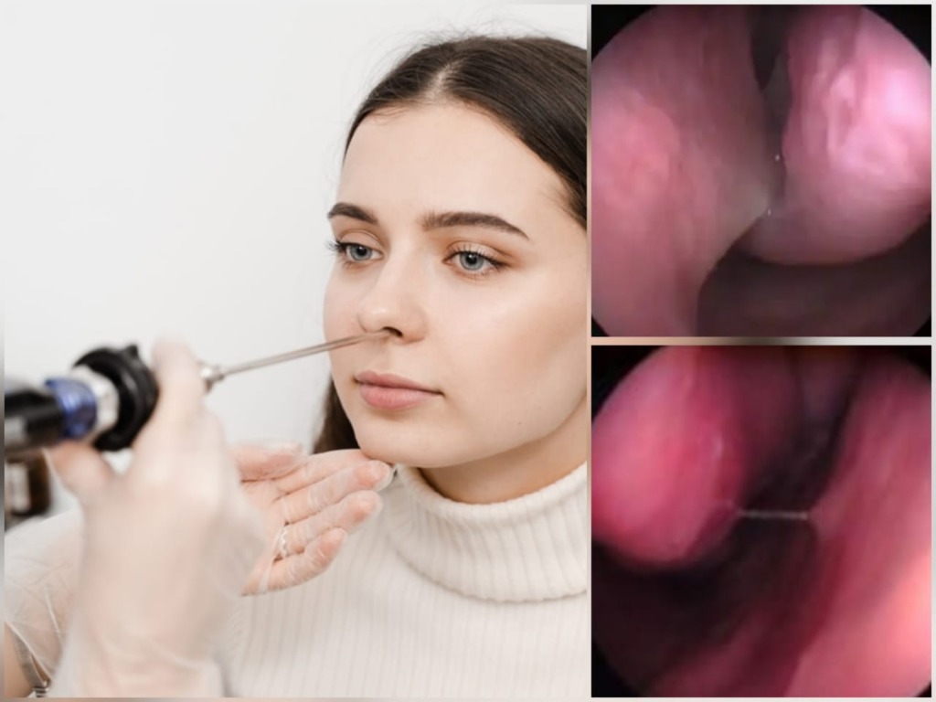Endoscopia nasal com óptica rígida - paciente sendo examinada e visualizações endoscópicas da cavidade nasal