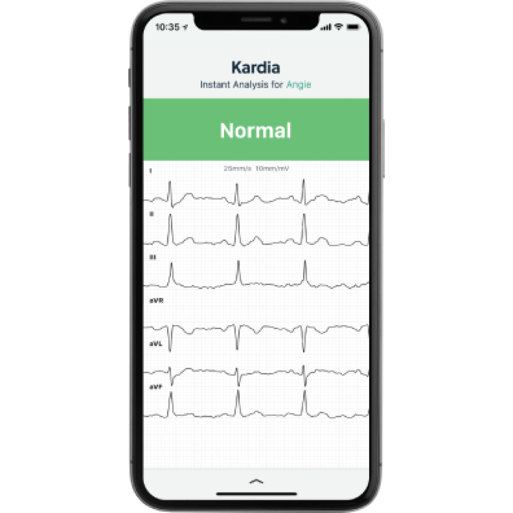 Interface do aplicativo Kardia mostrando análise instantânea de ECG normal com 6 derivações